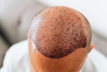 FUE TRANSPLANT